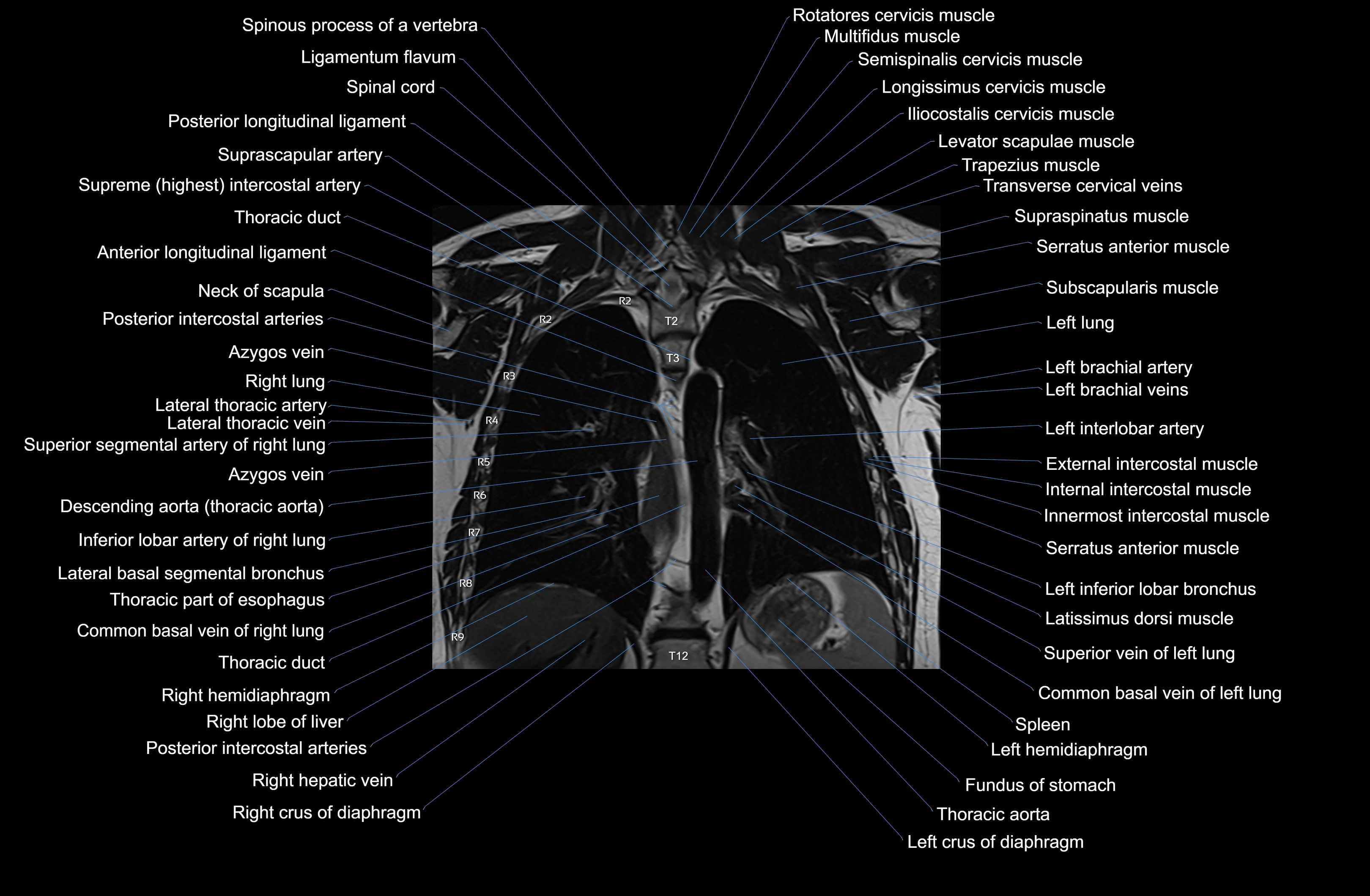 MRI chest (thorax) coronal  cross sectional anatomy 3T radiology  image-img-00001-00027.webp